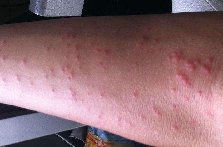 虫咬性皮炎皮损症状
